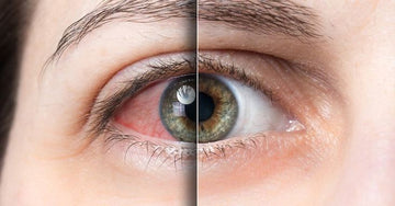 Are You in the 95% with Untreated Dry Eye Disease?