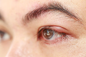 The Best Methods for Soothing Irritated Eyelids