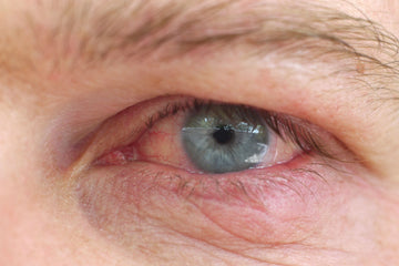 Dry Eye Severity: How to Determine Severity & Treatment