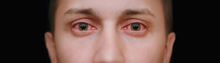 Why Allergies Make Your Eyes Red and Itchy