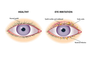 Common Therapies for Blepharitis and Other Eyelid Irritation