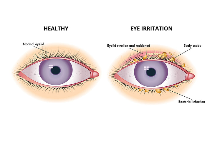 Common Therapies for Blepharitis and Other Eyelid Irritation