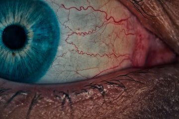 Eye Inflammation: The Hallmark of All Ocular Surface Disease