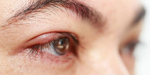 Posterior Blepharitis: Management, Treatment, and Prevention