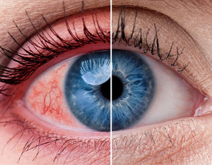 Fact: 30 Million Americans Suffer From Inflamed, Itchy Or Crusty Eyelids