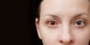 Dry Eye Syndrome: What It Is and What to Do About It