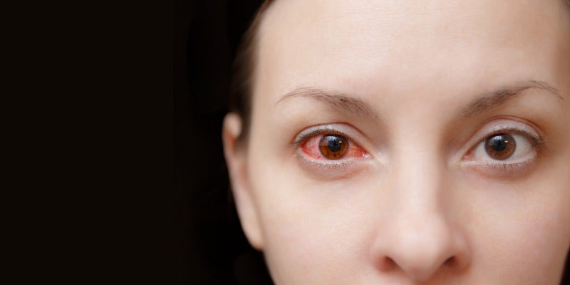 Dry Eye Syndrome: What It Is and What to Do About It