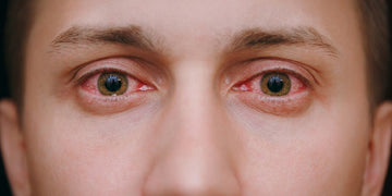 Why Allergies Make Your Eyes Red and Itchy