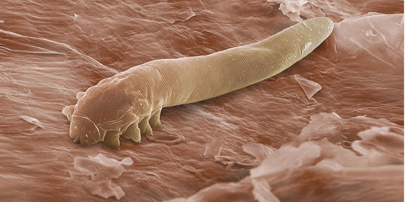 Myths and Facts of Demodex Blepharitis